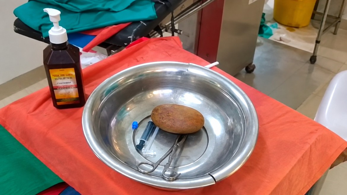 Stone removed from body