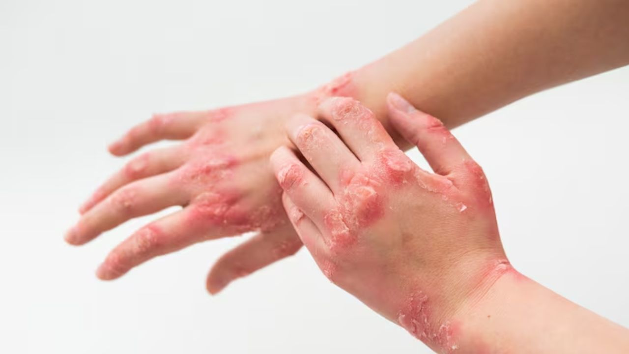 hand infection