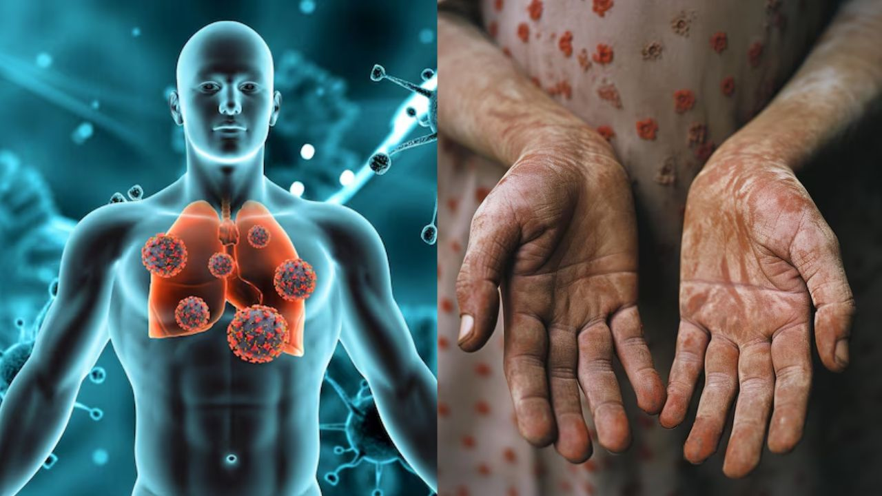 Tuberculosis and leprosy disease
