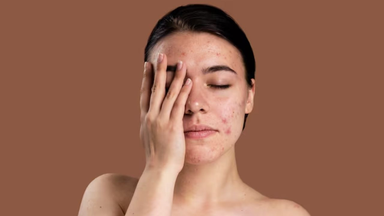 Skin care tips monsoon