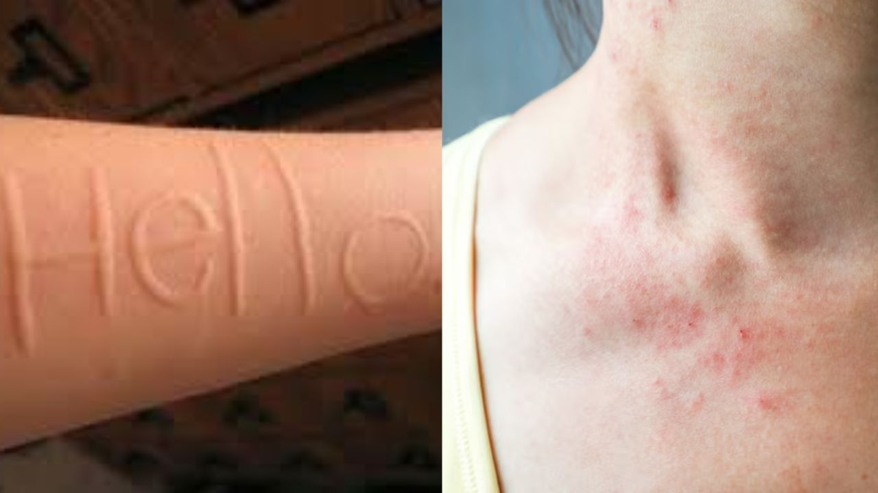 skin writing disease