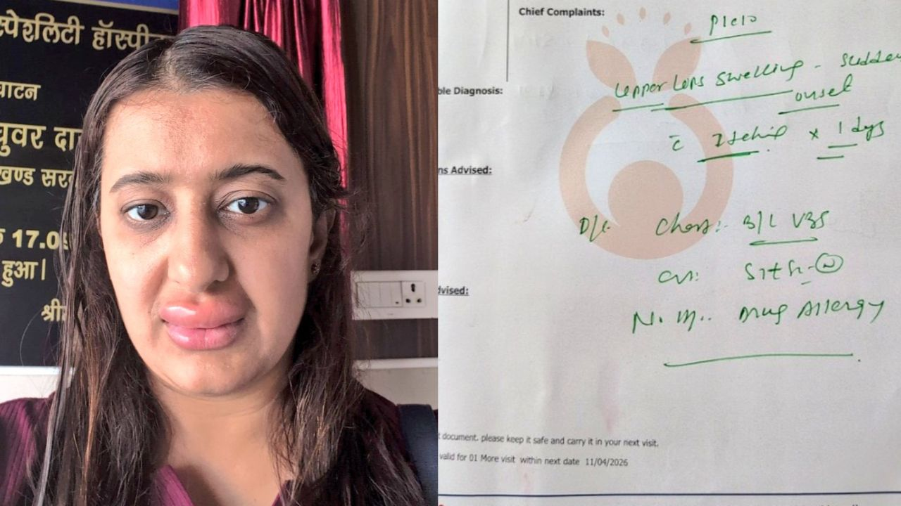 Vande Bharat train woman lips swollen eating food