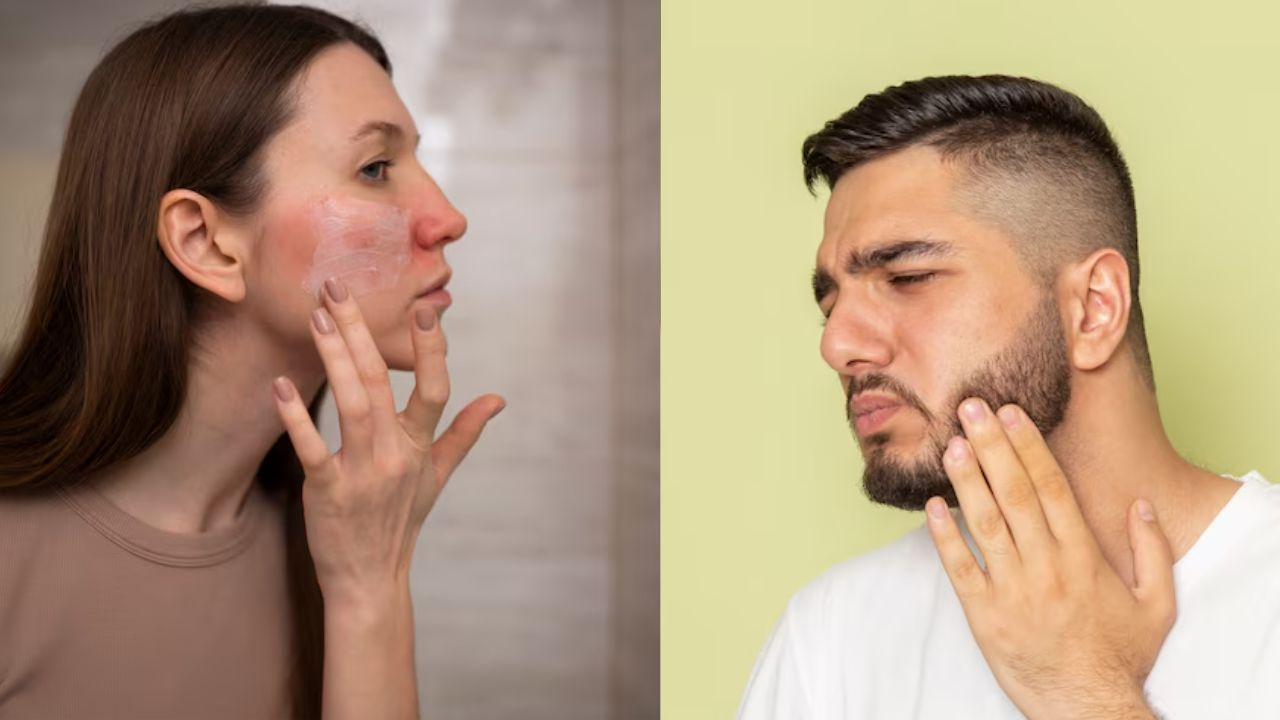 beard burn