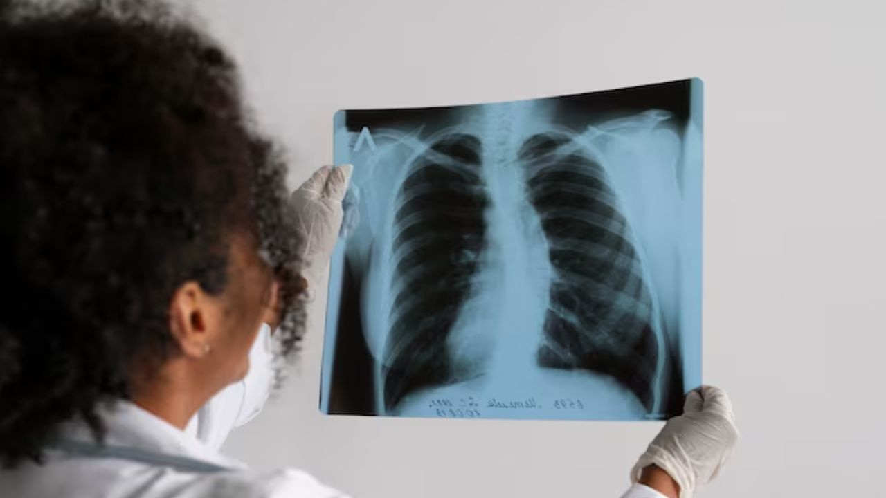 Lung Cancer