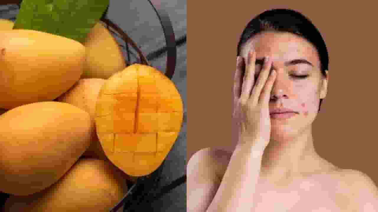 mango can cause pimples