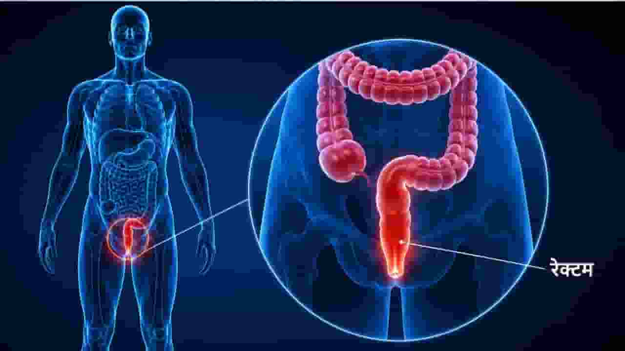 rectal cancer