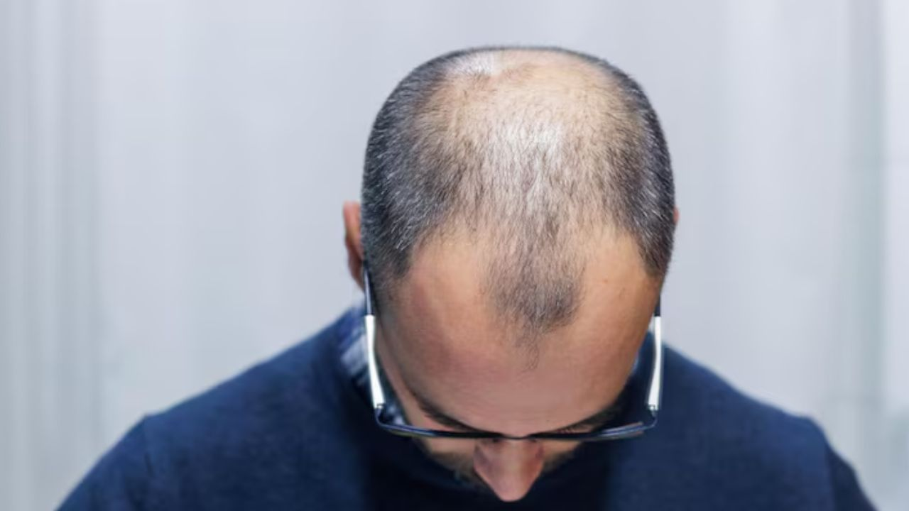 hair transplant