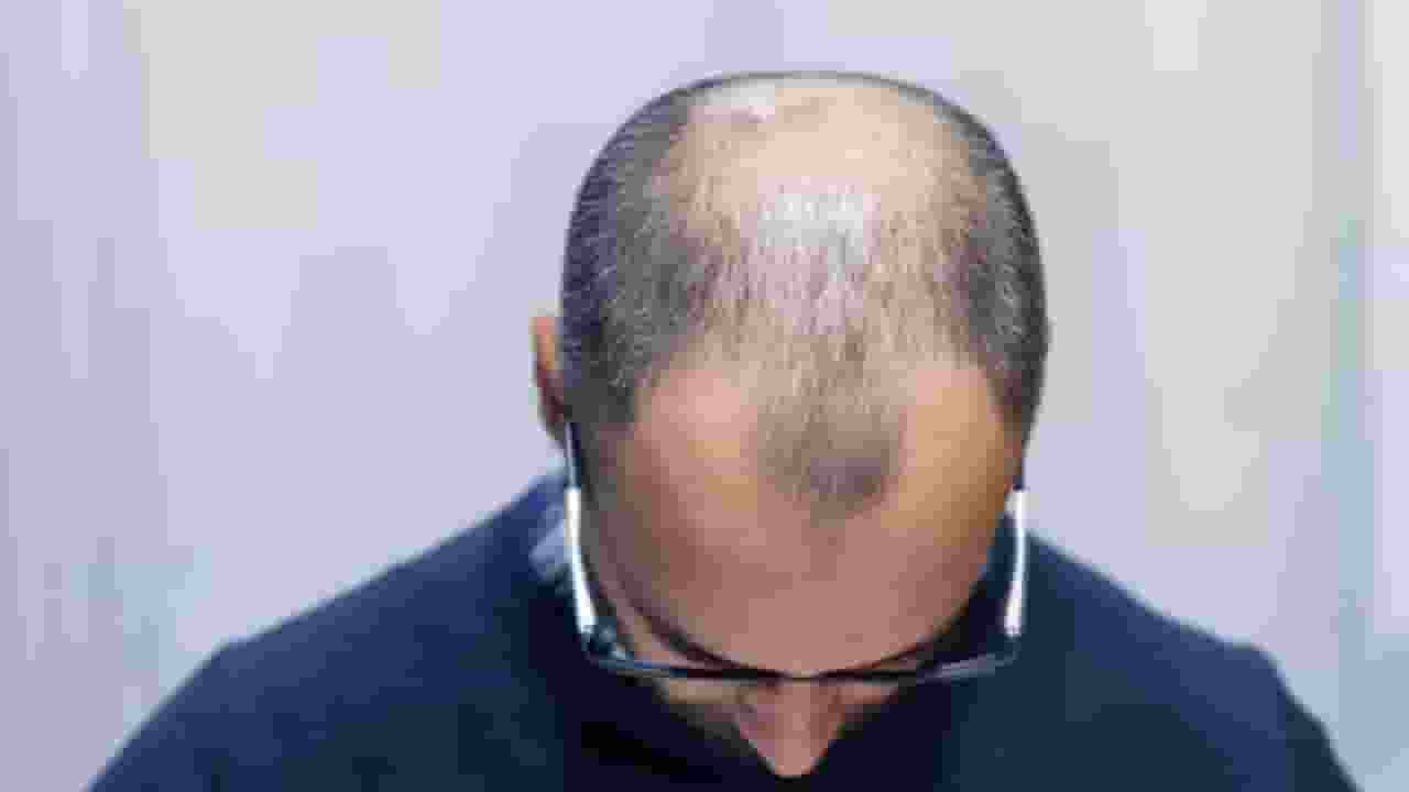 hair transplant