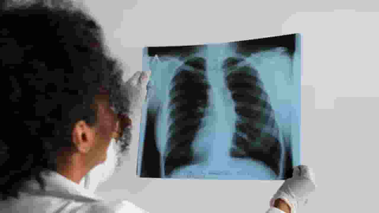 World Lung Cancer Day: क्या होता है फेफड़ों का कैंसर? जानें लक्षण Lung Cancer