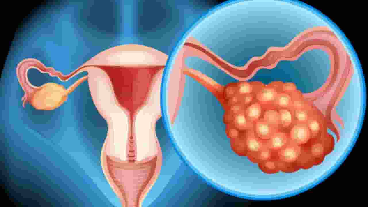 ओवेरियन कैंसर को कहा जाता है 'साइलेंट किलर', जानें बचाव और लक्षण ovarian cancer