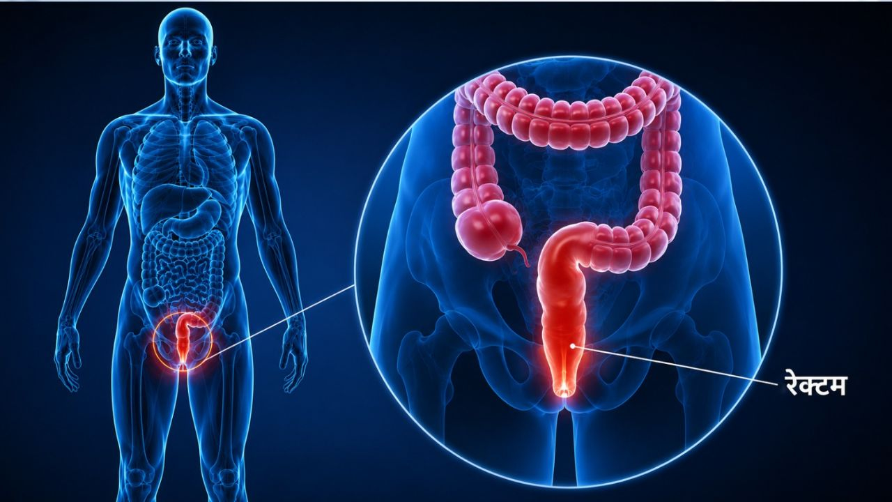 rectal cancer