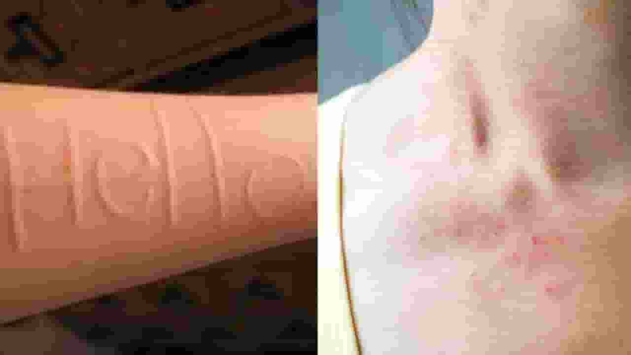 डर्मेटोग्राफिया बीमारी में त्वचा पर लिख सकते हैं शब्द, जानिए लक्षण
skin writing disease